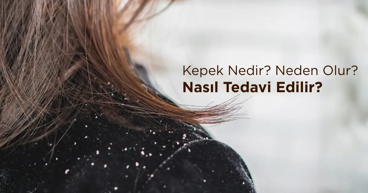 Kepek Nedir? Neden Olur? Nasıl Tedavi Edilir?