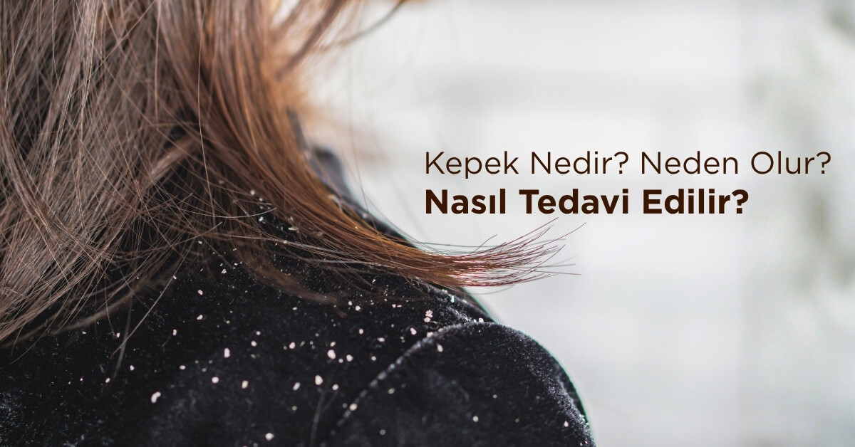 Kepek Nedir? Neden Olur? Nasıl Tedavi Edilir?