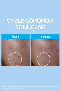 La Roche Posay Yağlı ve Akneye Eğilimli Ciltler için Güneş Bakım Seti - 5